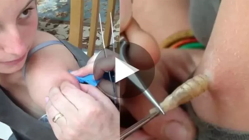 MEU DEUS! Ela Pensou Que Era TUM0R, Mas Na Verdade Olha Só O Que Saiu Do Braço Dela… Ver Mais