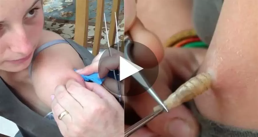 MEU DEUS! Ela Pensou Que Era TUM0R, Mas Na Verdade Olha Só O Que Saiu Do Braço Dela… Ver Mais