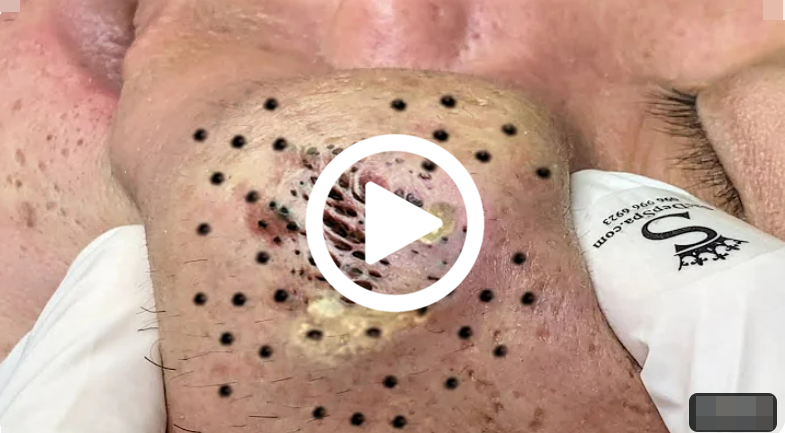 Cravo preto sendo removido, você não vai acreditar no que saiu de dentro; veja o vídeo