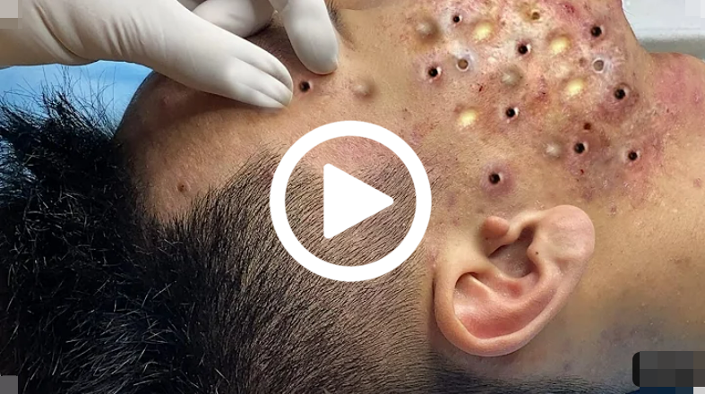 Você vai ficar em CHOQUE com o que saiu da espinha; veja o vídeo