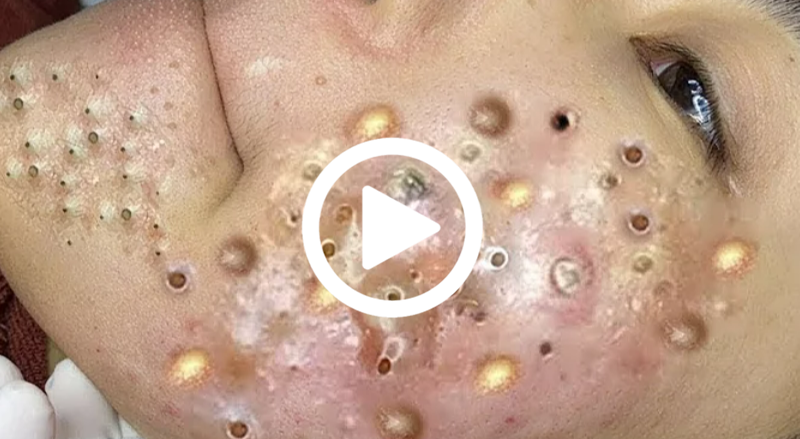 Removendo espinha GIGANTE, você não vai acreditar no que saiu; Veja o vídeo