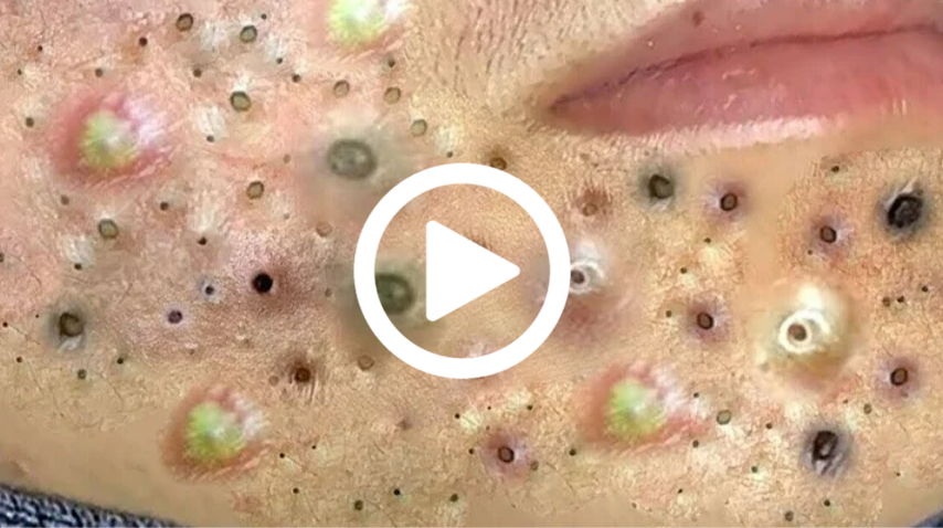 Cravo preto sendo removido, você não vai acreditar no que saiu de dentro; veja o vídeo