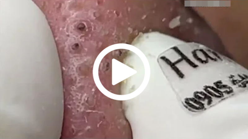 Cravo preto sendo removido, você não vai acreditar no que saiu de dentro; veja o vídeo