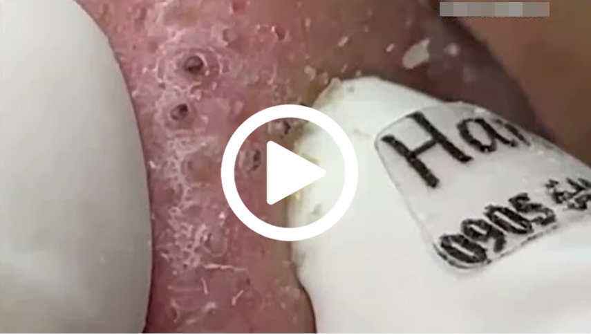 Cravo preto sendo removido, você não vai acreditar no que saiu de dentro; veja o vídeo