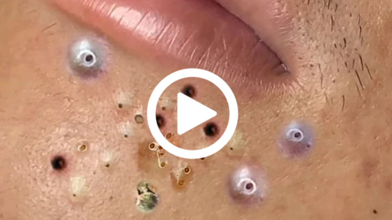 Você vai ficar em CHOQUE com o que saiu da espinha; veja o vídeo