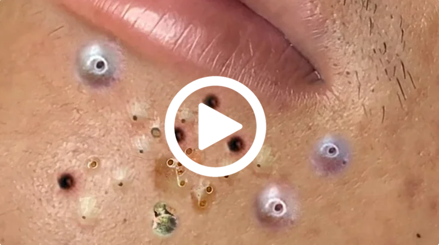 Você vai ficar em CHOQUE com o que saiu da espinha; veja o vídeo