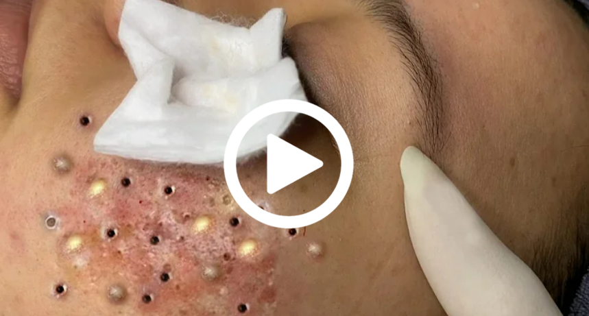 Cravo preto sendo removido, você não vai acreditar no que saiu de dentro; veja o vídeo