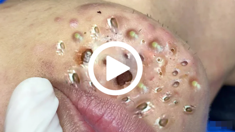 Cravo preto sendo removido, você não vai acreditar no que saiu de dentro; veja o vídeo