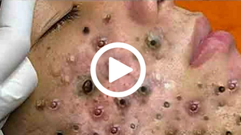 Você vai ficar em CHOQUE com o que saiu da espinha; veja o vídeo