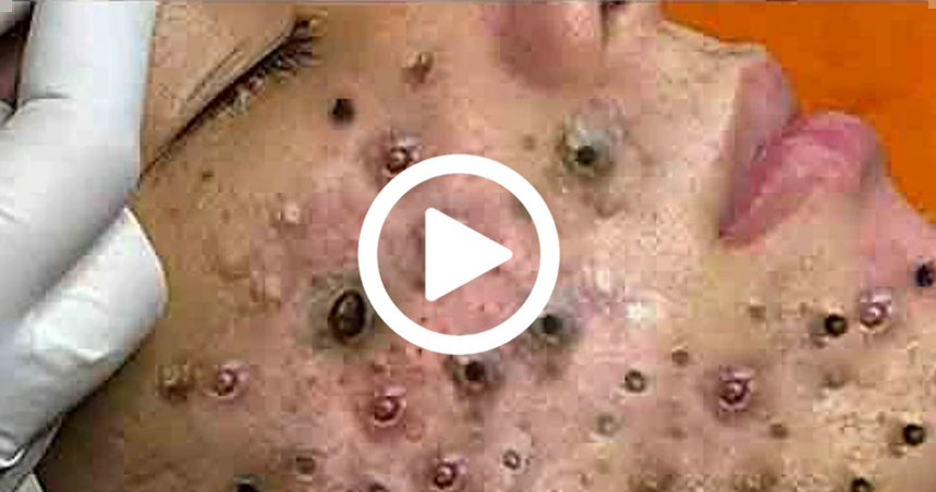 Você vai ficar em CHOQUE com o que saiu da espinha; veja o vídeo