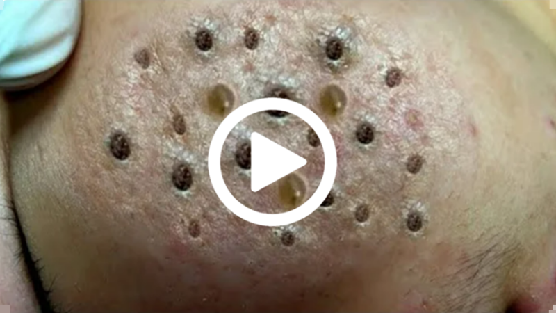 Cravo preto sendo removido, você não vai acreditar no que saiu de dentro; veja o vídeo