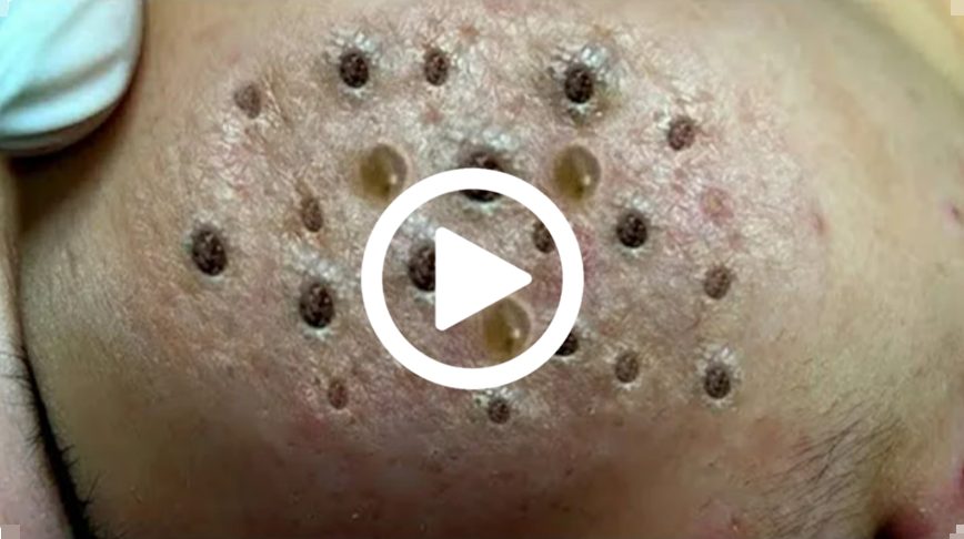 Cravo preto sendo removido, você não vai acreditar no que saiu de dentro; veja o vídeo