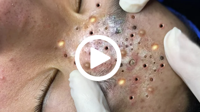 Cravo preto sendo removido, você não vai acreditar no que saiu de dentro; veja o vídeo