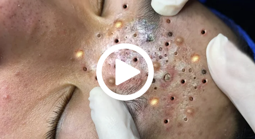 Cravo preto sendo removido, você não vai acreditar no que saiu de dentro; veja o vídeo