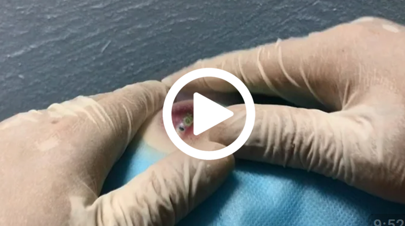 Cravo preto sendo removido, você não vai acreditar no que saiu de dentro; veja o vídeo