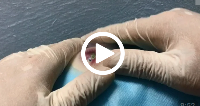 Cravo preto sendo removido, você não vai acreditar no que saiu de dentro; veja o vídeo