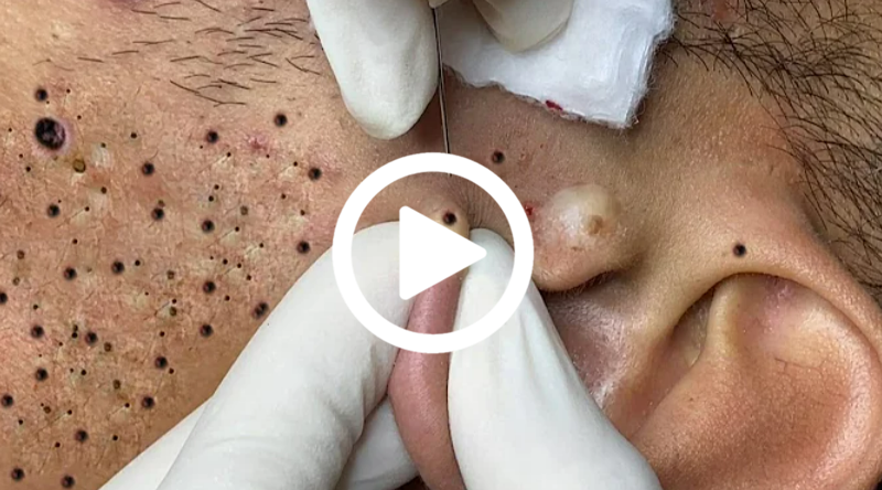 Cravo preto sendo removido, você não vai acreditar no que saiu de dentro; veja o vídeo