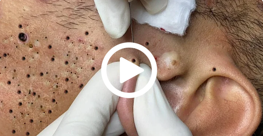 Cravo preto sendo removido, você não vai acreditar no que saiu de dentro; veja o vídeo