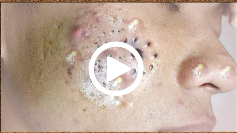 Removendo espinha GIGANTE, você não vai acreditar no que saiu; Veja o vídeo