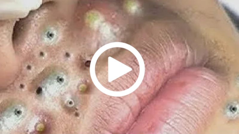 Cravo preto sendo removido, você não vai acreditar no que saiu de dentro; veja o vídeo