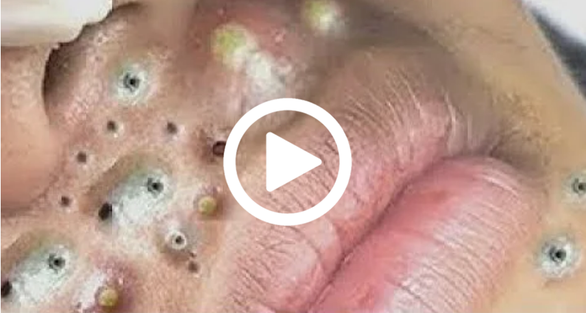 Cravo preto sendo removido, você não vai acreditar no que saiu de dentro; veja o vídeo