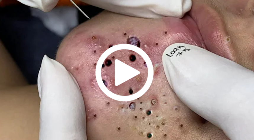 Cravo preto sendo removido, você não vai acreditar no que saiu de dentro; veja o vídeo