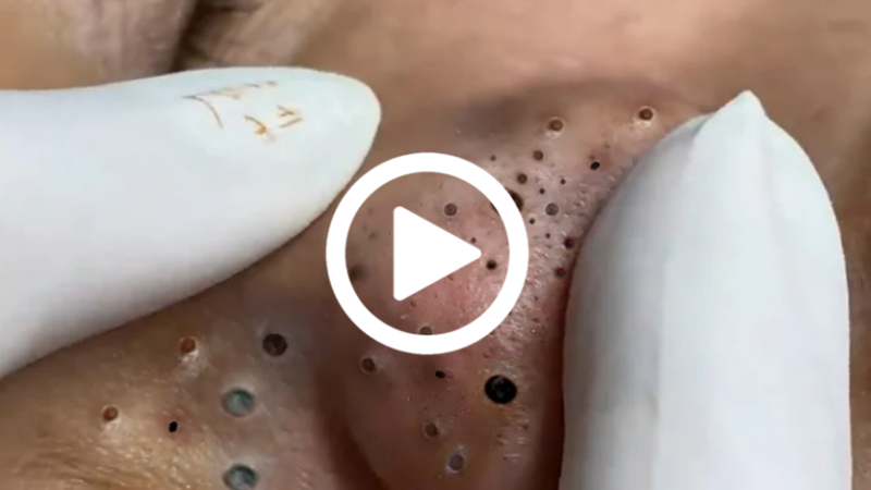 Cravo preto sendo removido, você não vai acreditar no que saiu de dentro; veja o vídeo