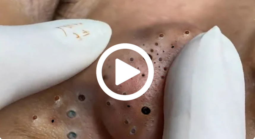 Cravo preto sendo removido, você não vai acreditar no que saiu de dentro; veja o vídeo