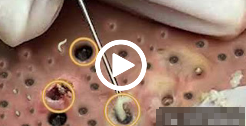 Cravo preto sendo removido, você não vai acreditar no que saiu de dentro; veja o vídeo