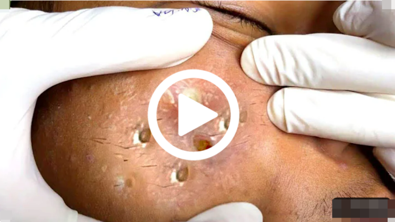 Cravo preto sendo removido, você não vai acreditar no que saiu de dentro; veja o vídeo