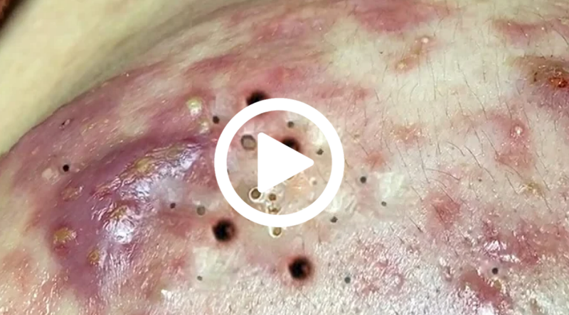 Cravo preto sendo removido, você não vai acreditar no que saiu de dentro; veja o vídeo