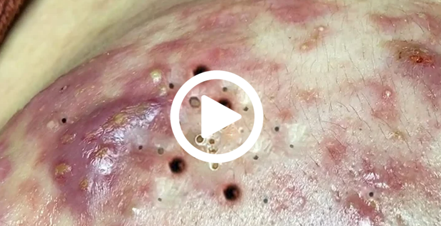 Cravo preto sendo removido, você não vai acreditar no que saiu de dentro; veja o vídeo