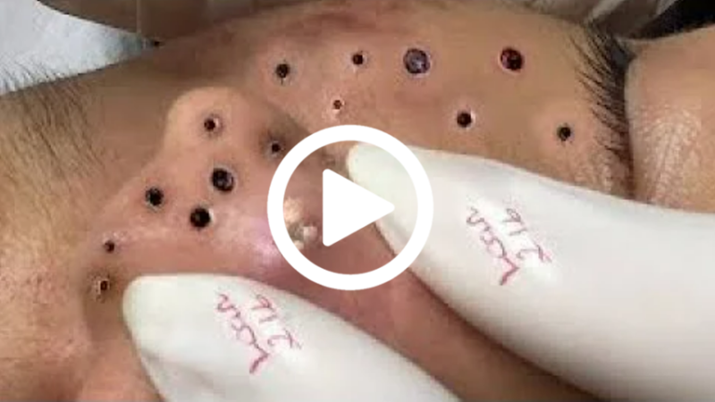 Cravo preto sendo removido, você não vai acreditar no que saiu de dentro; veja o vídeo