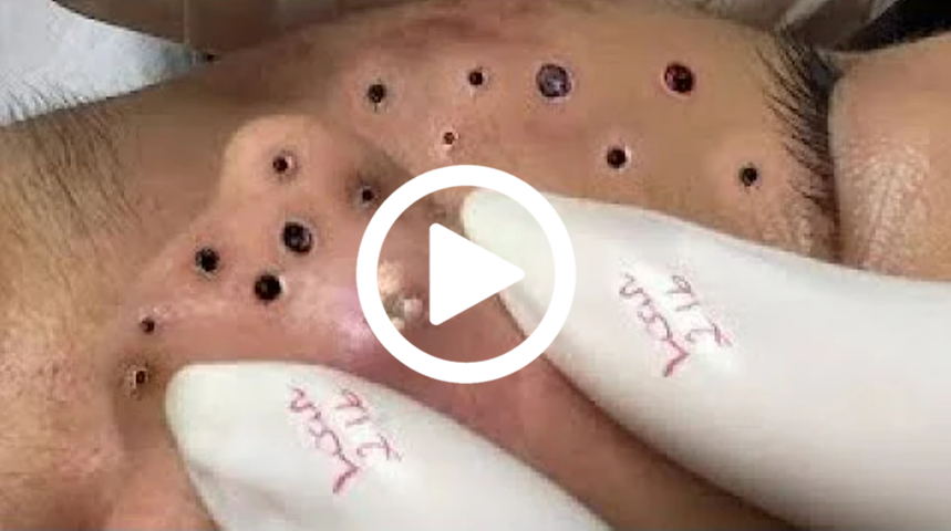 Cravo preto sendo removido, você não vai acreditar no que saiu de dentro; veja o vídeo