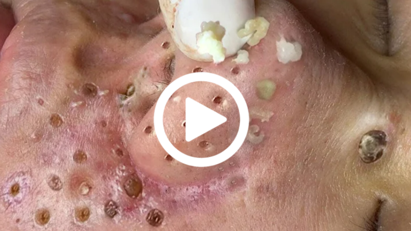 Cravo preto sendo removido, você não vai acreditar no que saiu de dentro; veja o vídeo