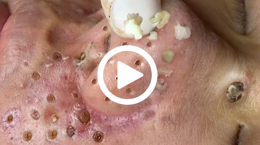 Cravo preto sendo removido, você não vai acreditar no que saiu de dentro; veja o vídeo