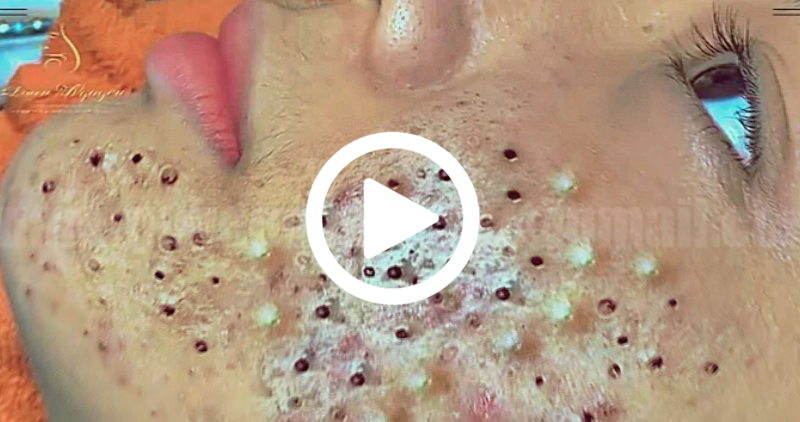 Cravo preto sendo removido, você não vai acreditar no que saiu de dentro; veja o vídeo