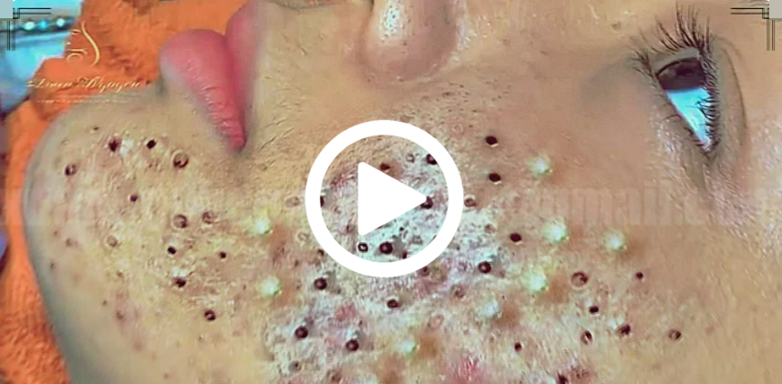 Cravo preto sendo removido, você não vai acreditar no que saiu de dentro; veja o vídeo