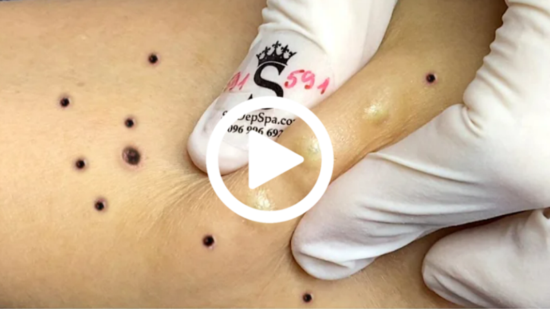 Cravo preto sendo removido, você não vai acreditar no que saiu de dentro; veja o vídeo