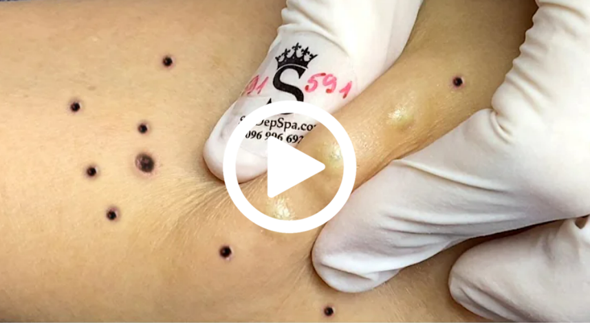 Cravo preto sendo removido, você não vai acreditar no que saiu de dentro; veja o vídeo