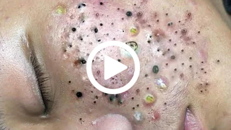 Cravo preto sendo removido, você não vai acreditar no que saiu de dentro; veja o vídeo