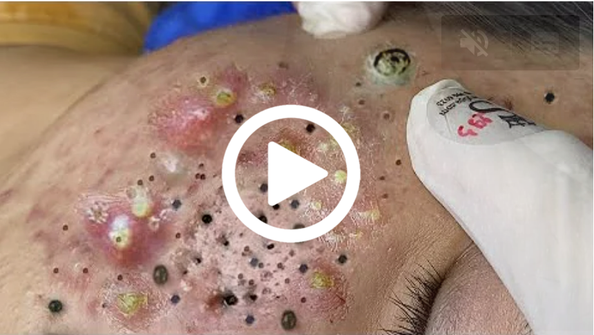 Cravo preto sendo removido, você não vai acreditar no que saiu de dentro; veja o vídeo