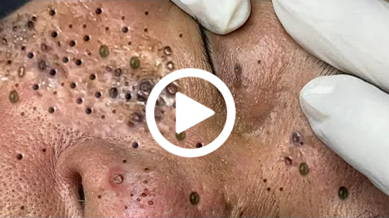 Cravo preto sendo removido, você não vai acreditar no que saiu de dentro; veja o vídeo