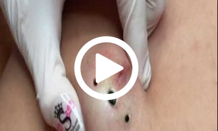 Cravo preto sendo removido, você não vai acreditar no que saiu de dentro; veja o vídeo