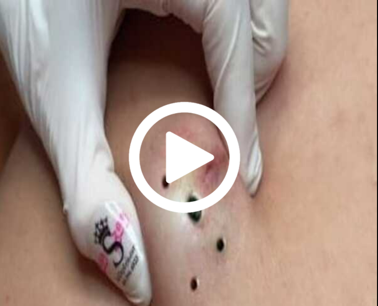 Cravo preto sendo removido, você não vai acreditar no que saiu de dentro; veja o vídeo