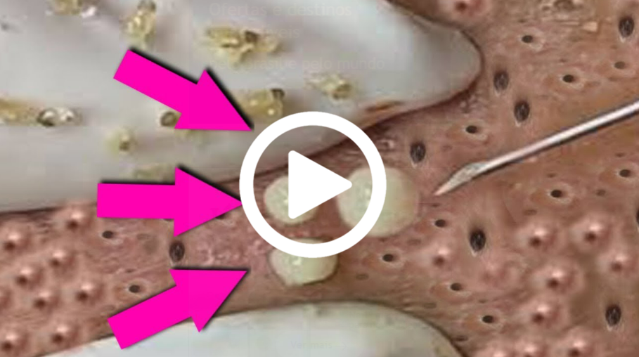 MEU DEUS! Ela Pensou Que Era TUM0R, Mas Na Verdade Olha Só O Que Saiu… Ver Mais