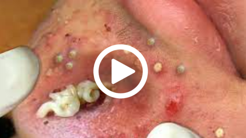 Cravo preto sendo removido, você não vai acreditar no que saiu de dentro; veja o vídeo