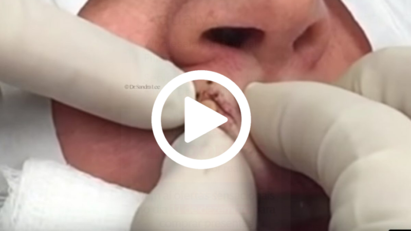 Cravo preto sendo removido, você não vai acreditar no que saiu de dentro; veja o vídeo