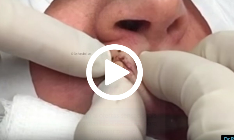 Cravo preto sendo removido, você não vai acreditar no que saiu de dentro; veja o vídeo