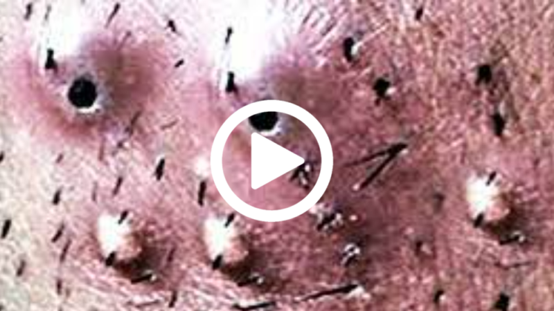 Cravo preto sendo removido, você não vai acreditar no que saiu de dentro; veja o vídeo